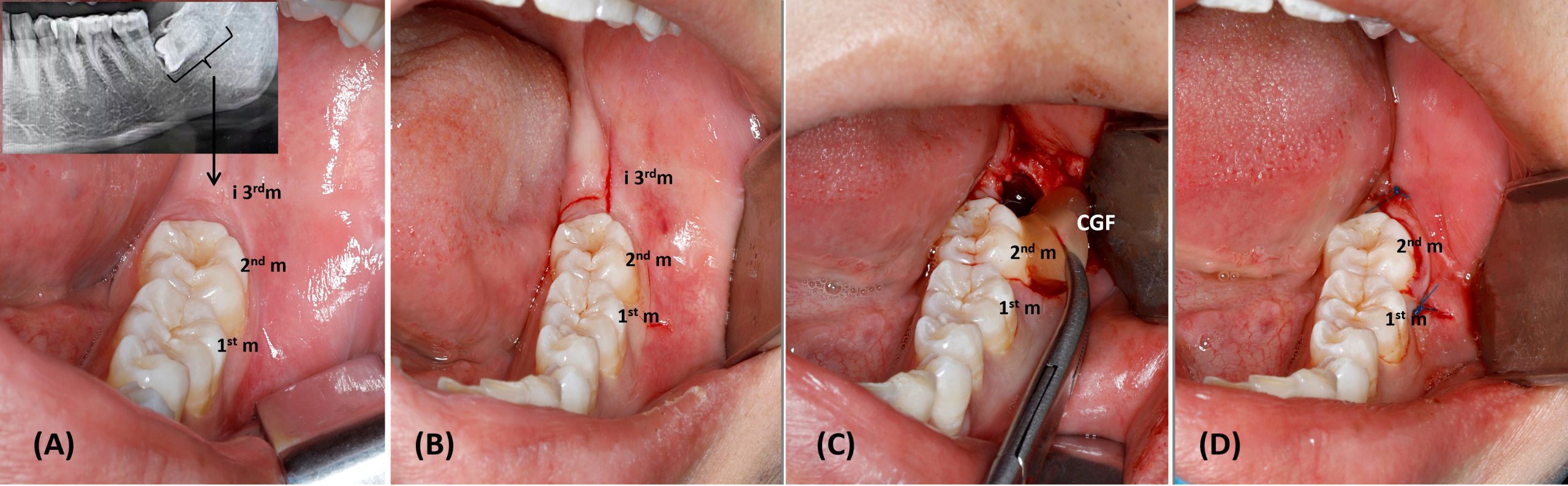 Is It Safe to Drink Soda After Wisdom Teeth Removal A Quick Guide