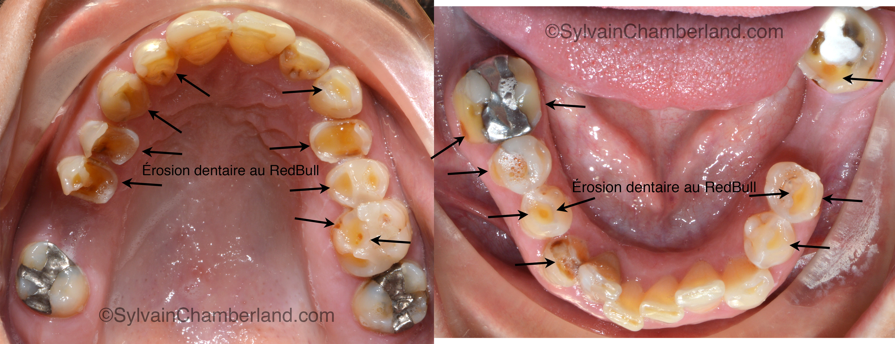 Red Bull and Your Teeth: What You Need to Know About the Risks