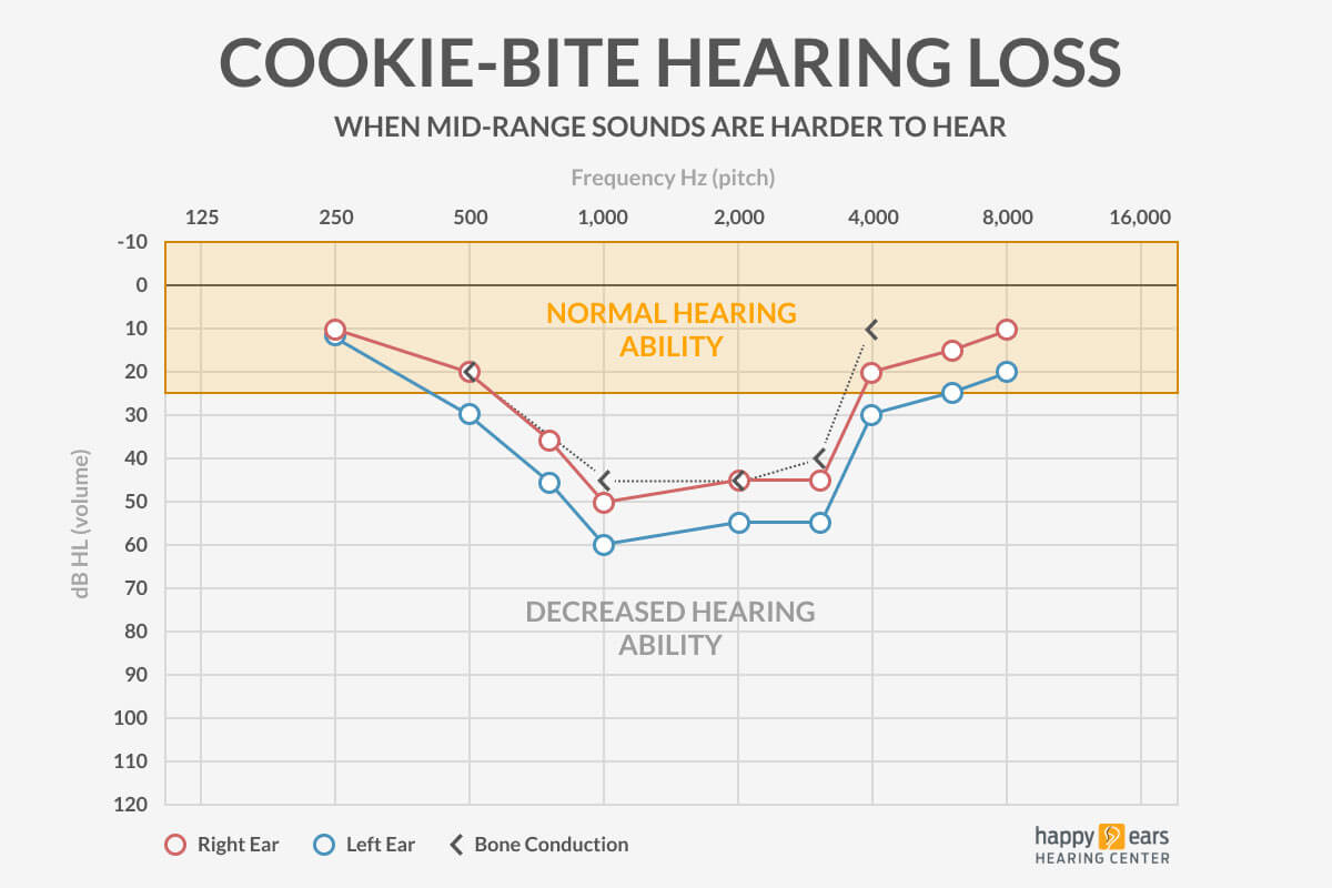 What is Cookie Bite Hearing Loss? Learn About This Hearing Condition and Get Simple Tips for a Better Life