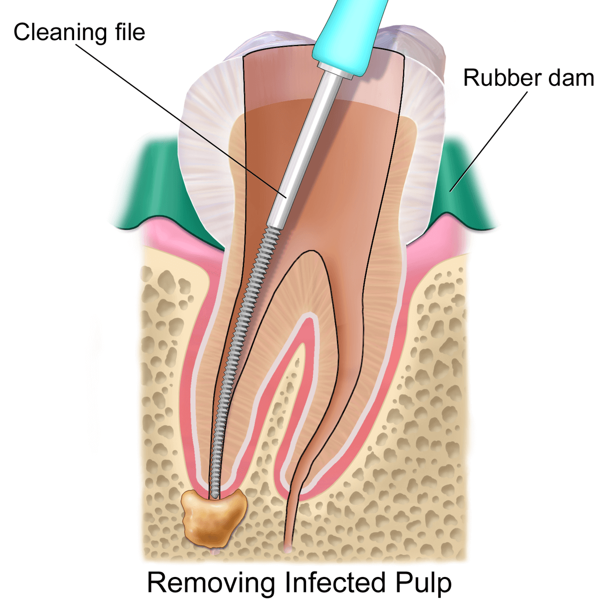 Before Root Canal, Can I Drink Something Cold?  Heres the Answer