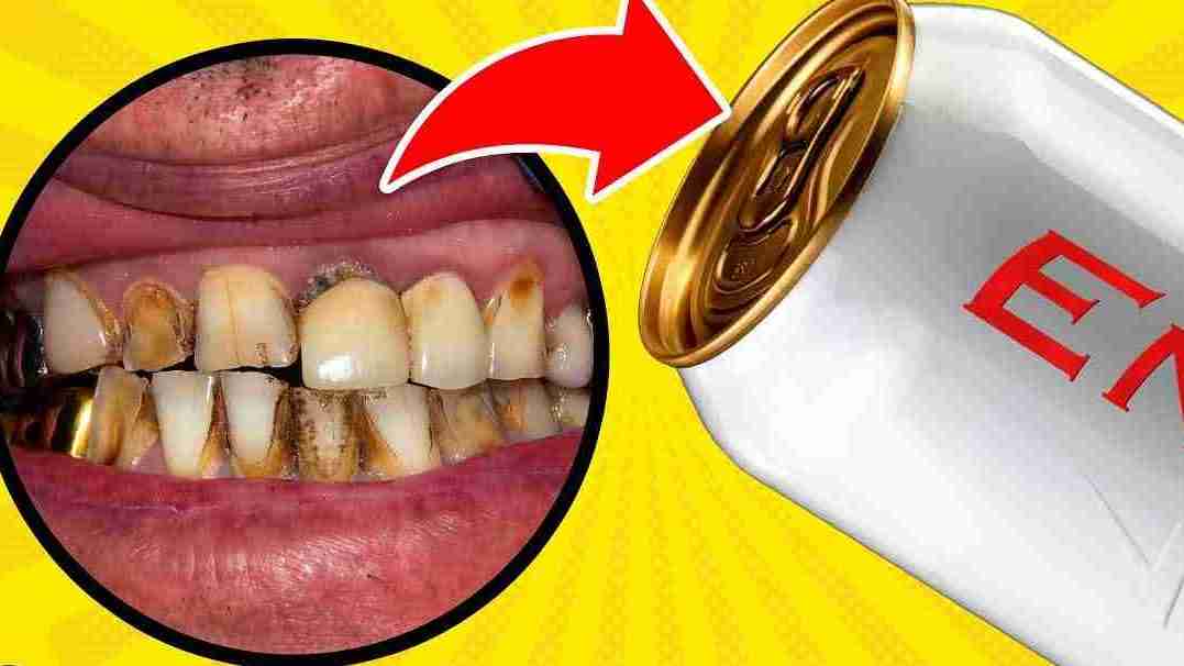 Red Bull and Your Teeth: What You Need to Know About the Risks