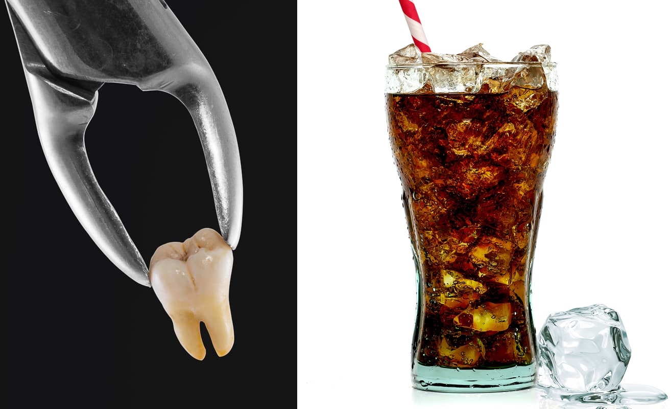 When can you drink carbonated drinks after tooth extraction? Simple tips for a safe recovery.